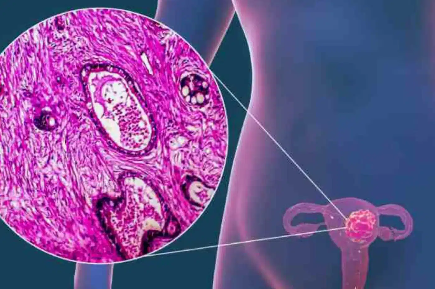 10 síntomas de endometriosis que deben detectarse a tiempo