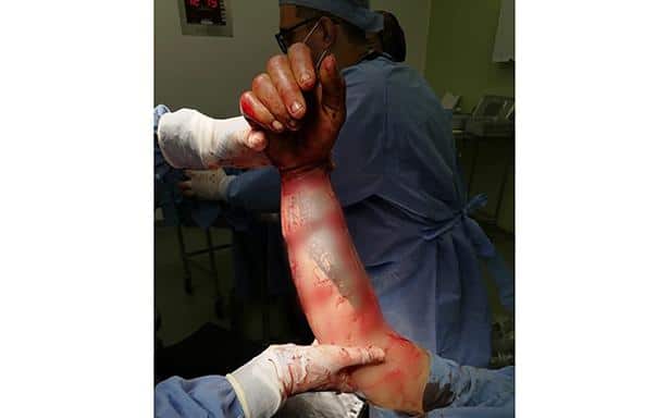 Médicos evitan amputar brazo de hombre de 34 años: historia