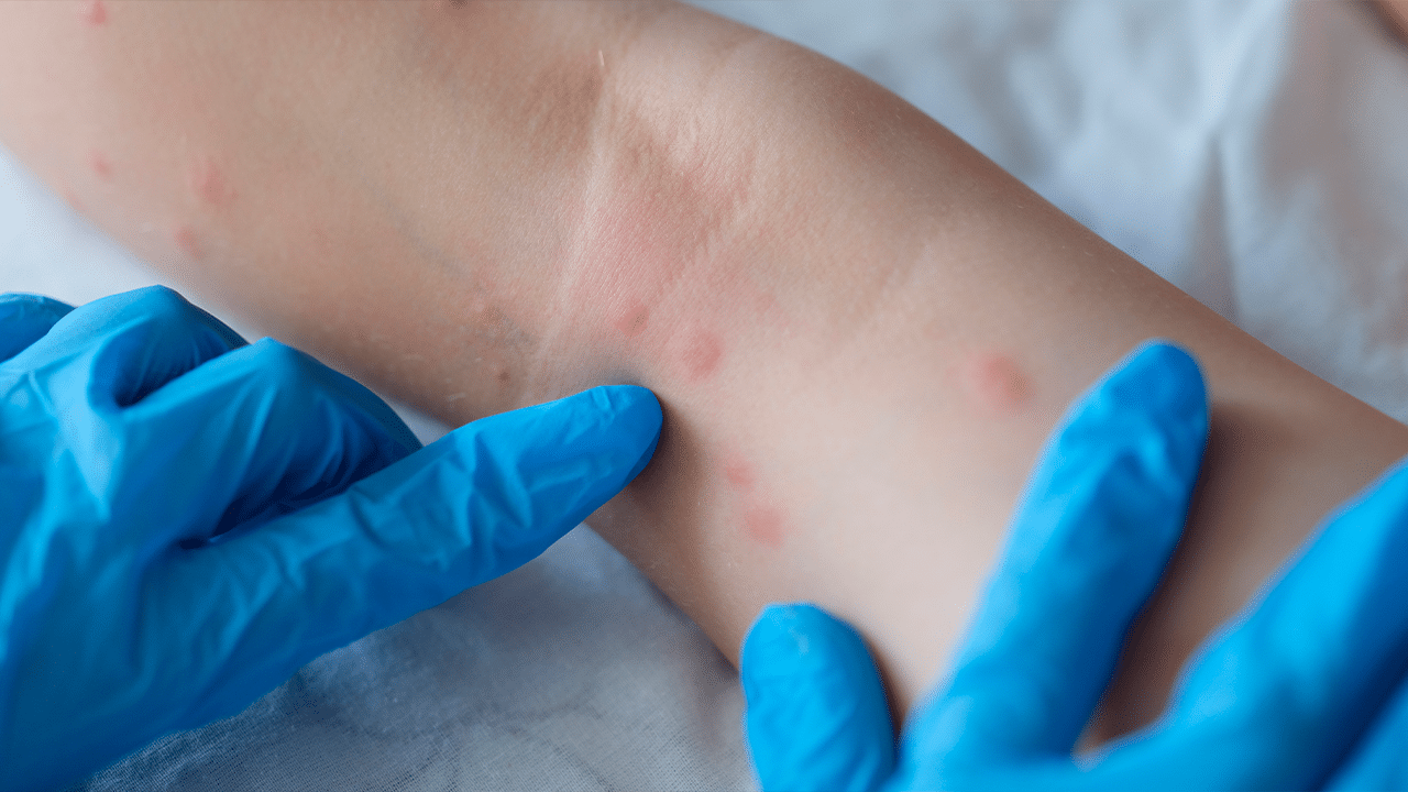 ¿Cuánto duran los síntomas de la viruela del mono?