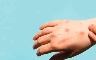 OMS aprueba primera vacuna contra la viruela del mono para niñas y niños