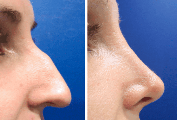 7 cosas que debes hacer después de una cirugía de nariz (rinoplastia)