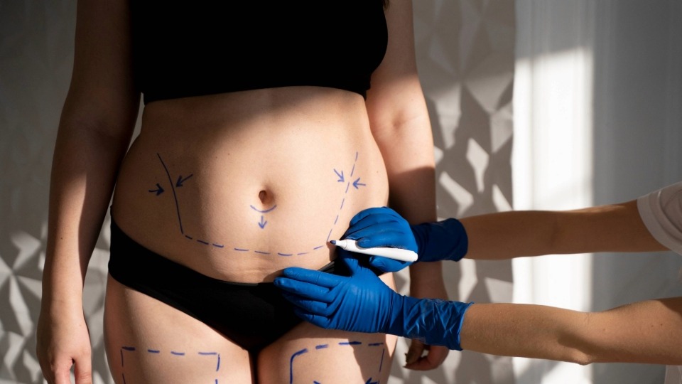 Liposucción en su propia casa le causó la muerte: esto sabemos