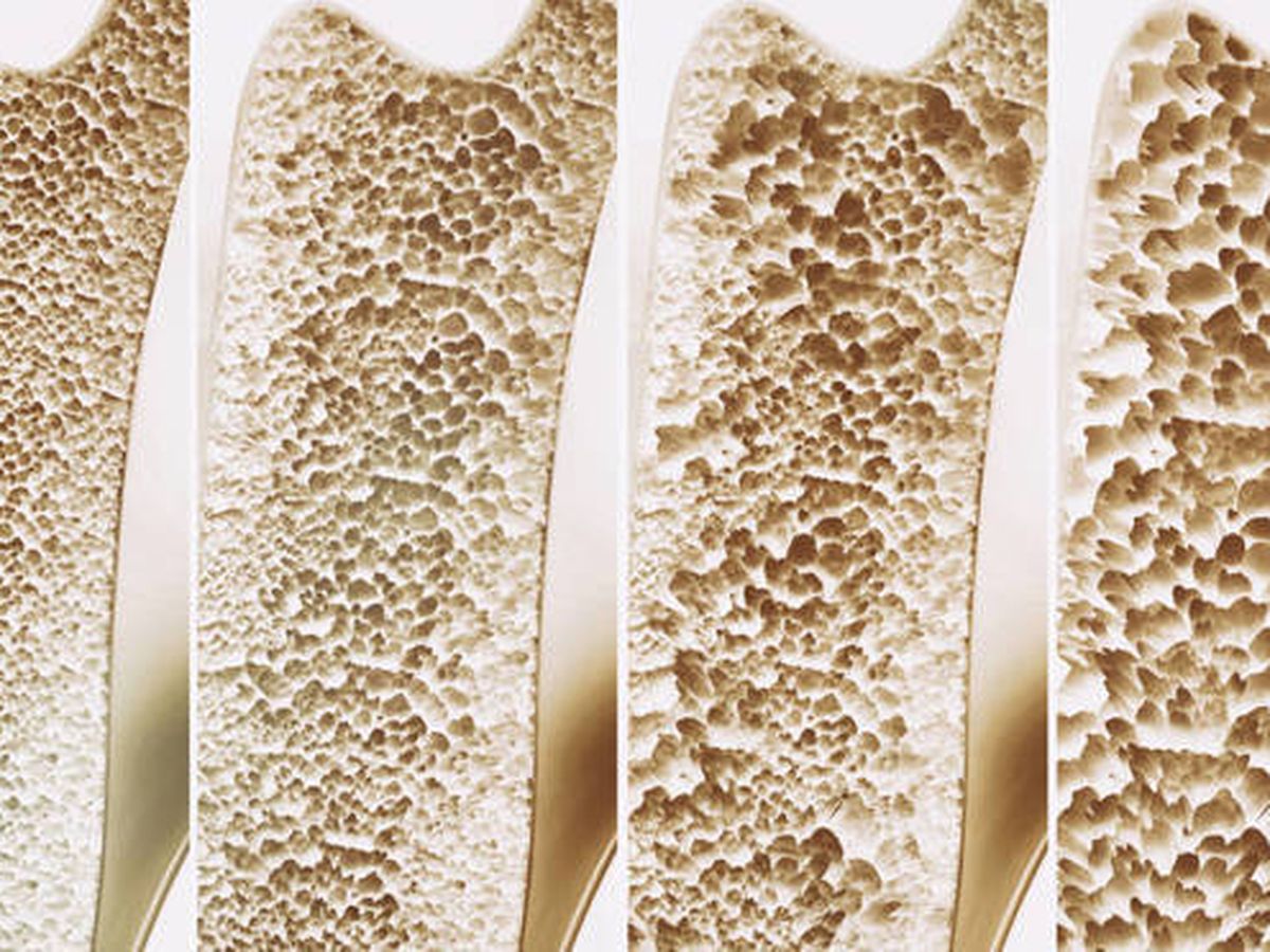 Identifican cinco factores de riesgo “raros” para osteoporosis