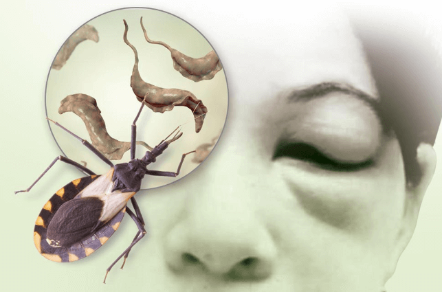 Jalisco con 800 casos sospechosos de enfermedad de Chagas al año, ¿cuáles son los síntomas?