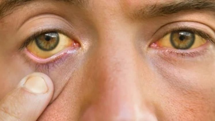 Declararán emergencia sanitaria en Colombia por “fiebre amarilla”, ¿qué es?