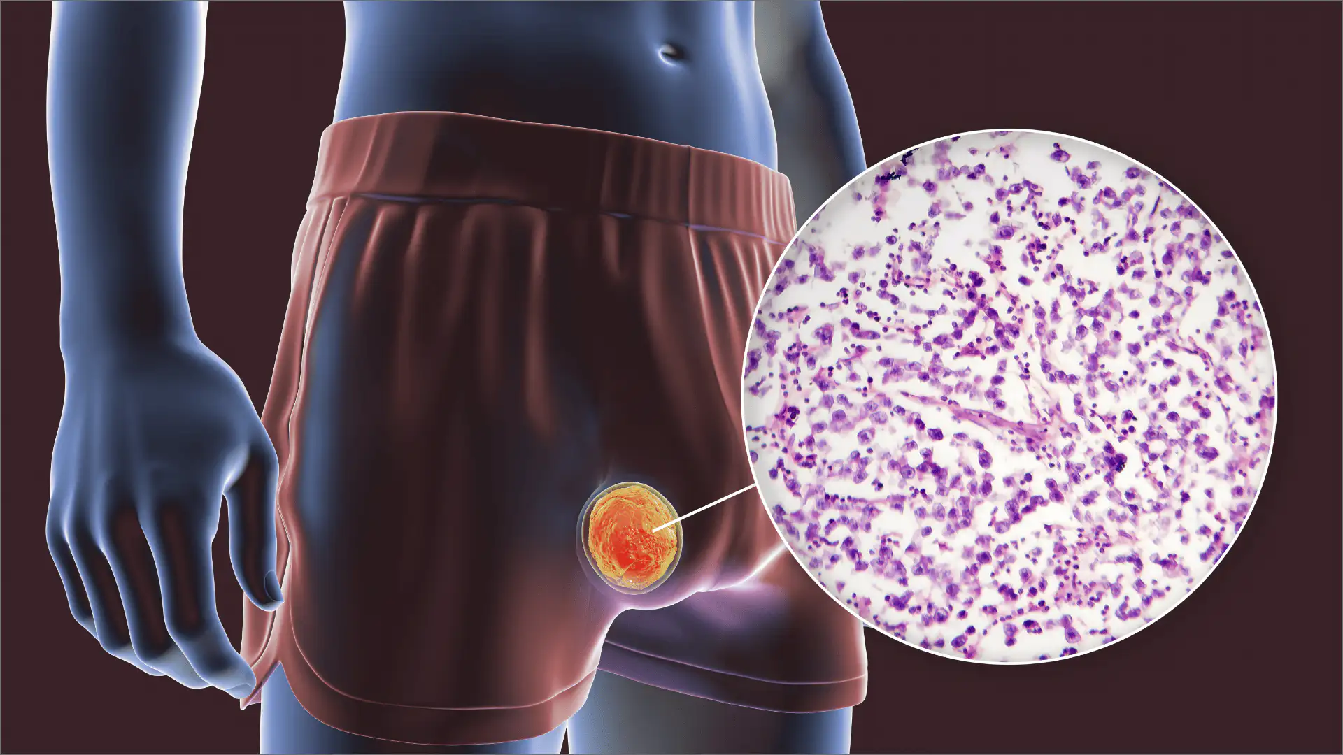 7 síntomas de cáncer en los testículos que debes identificar “a tiempo”