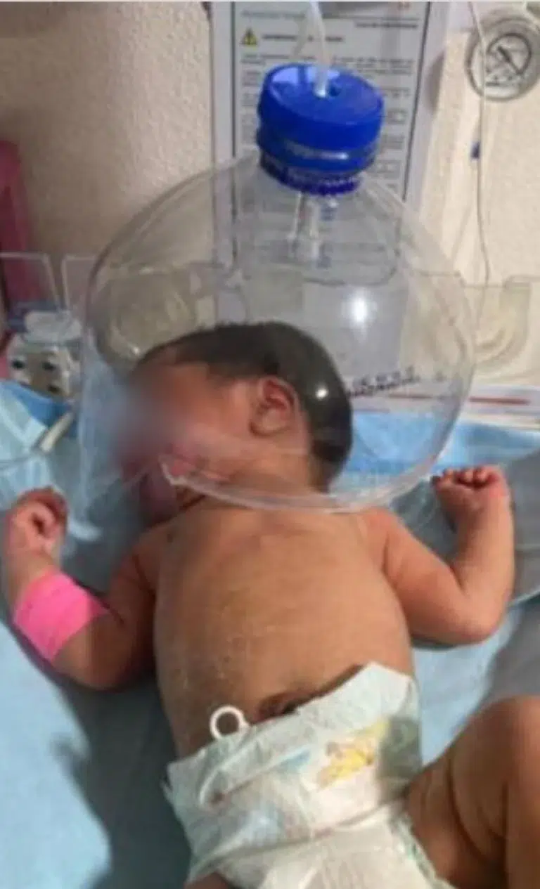 Falta de insumos hace que personal del IMSS use botella de plástico para oxigenar a un bebé.