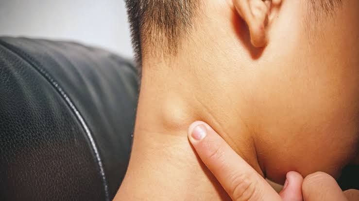 Ganglios agrandados pueden ser enfermedad de Chagas: ¿cómo prevenir?