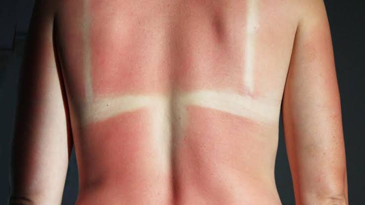 Cuidado vacacionistas: el bronceado “saludable” no existe