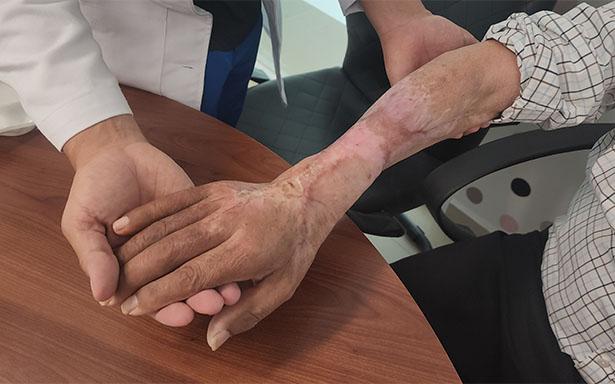 Salvan brazo de paciente con picadura de araña violinista: ¿cómo?
