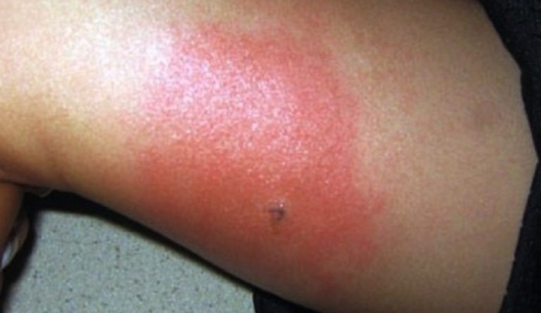 Alerta por alacranes en Jalisco: así puedes prevenir y atender sus picaduras