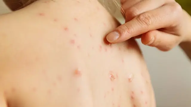 OPS confirma aumento de casos de sarampión en México y en redes culpan a l@s “antivacunas”