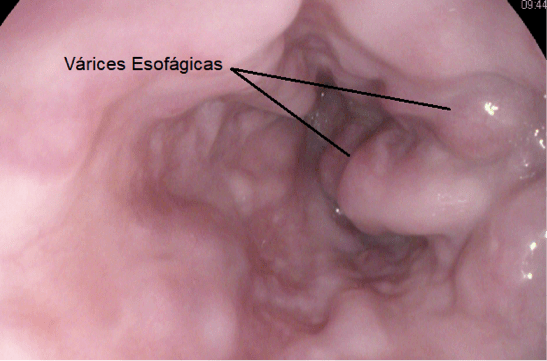 ¿Qué son las várices esofágicas? Expertos responden