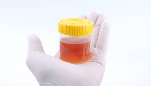 Color de la orina puede significar cáncer de vejiga: ¿qué color es peligroso?