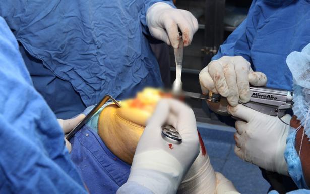 Artrosis degenerativa de rodilla acelera el desgaste de tus articulaciones, ¿qué es?