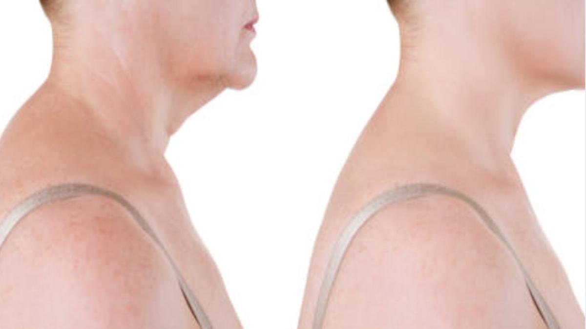 ¿Tienes “joroba digital”? Descubre qué es y cómo identificarla