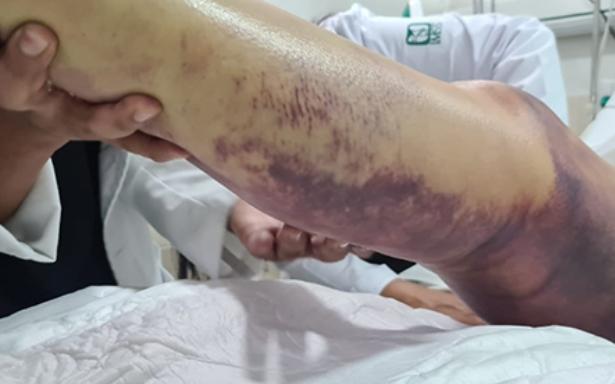 Especialistas mexicanos salvan la vida de joven que fue mordida en el tobillo por una peligrosa víbora