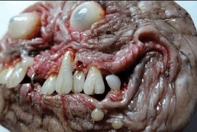 Teratoma: el tumor “monstruo” que espanta a cualquiera por su terrorífico aspecto