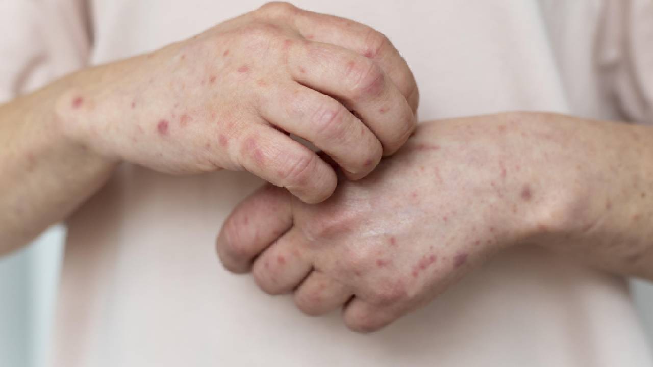 Despliegan equipo de respuesta por brote de sarampión en Chihuahua y piden identificar 3 síntomas