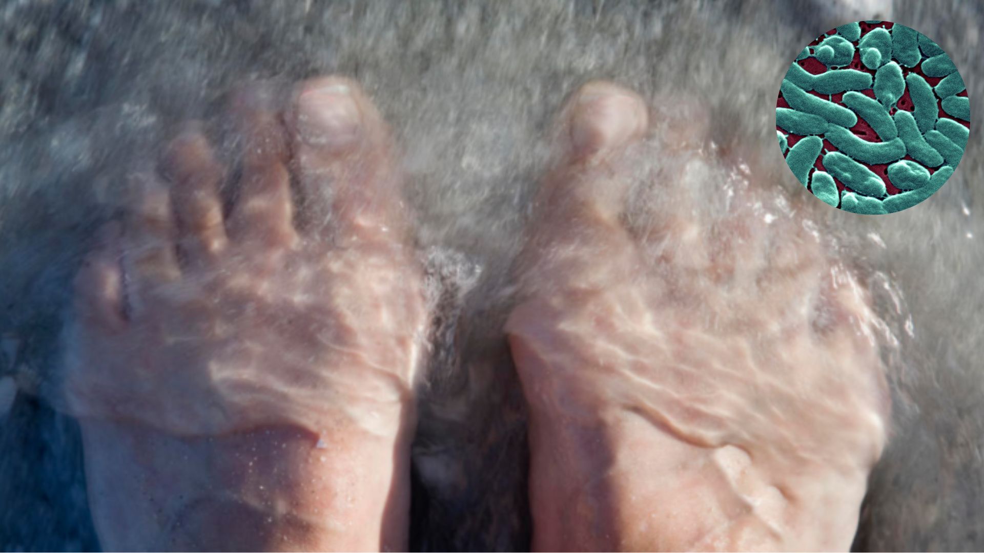 “Bacteria come carne” ha dejado cuatro muertes en Florida, ¿qué es y cómo prevenir?