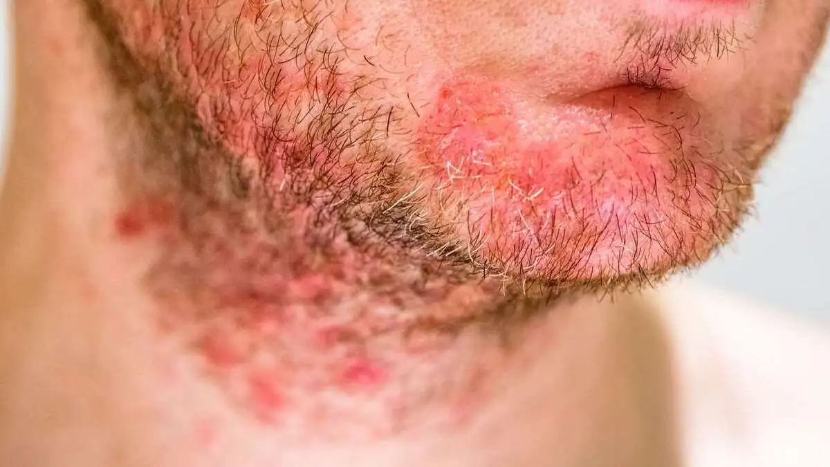 Puerto Vallarta tiene una de las mayores incidencias de VIH en Jalisco