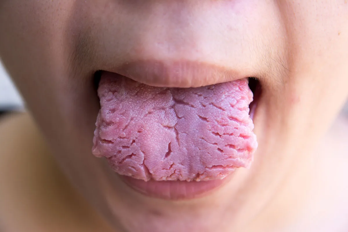 Raro síndrome cambia la lengua y disminuye las lágrimas y saliva, advierten