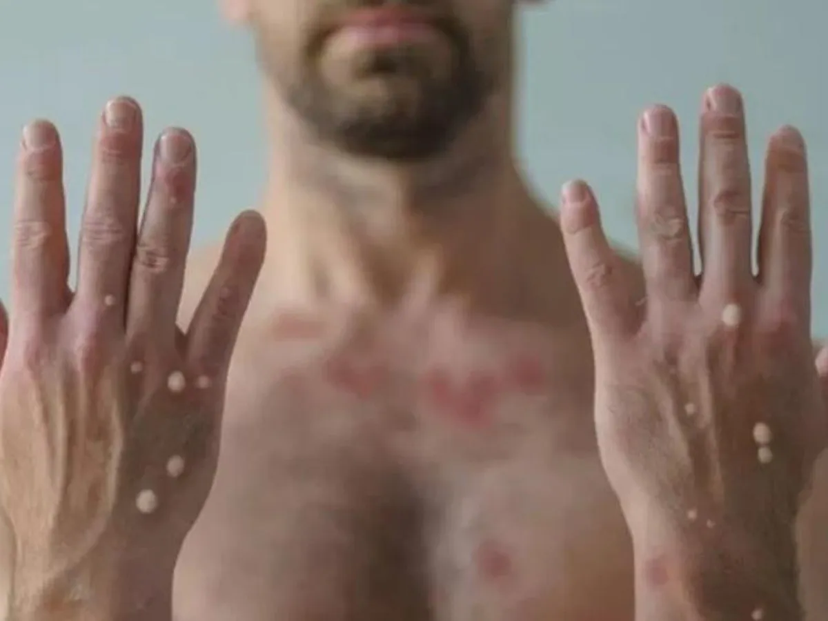 Confirman primera muerte por mpox “viruela del mono” en Jalisco