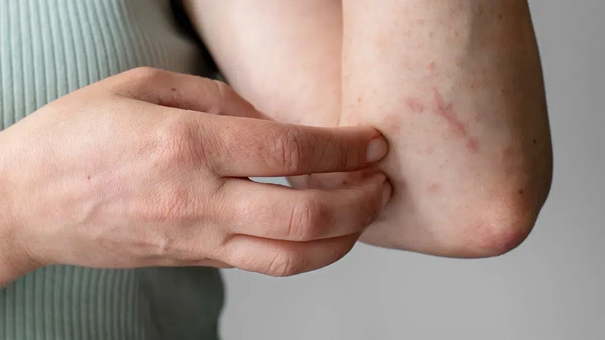 Seis síntomas iniciales del dengue