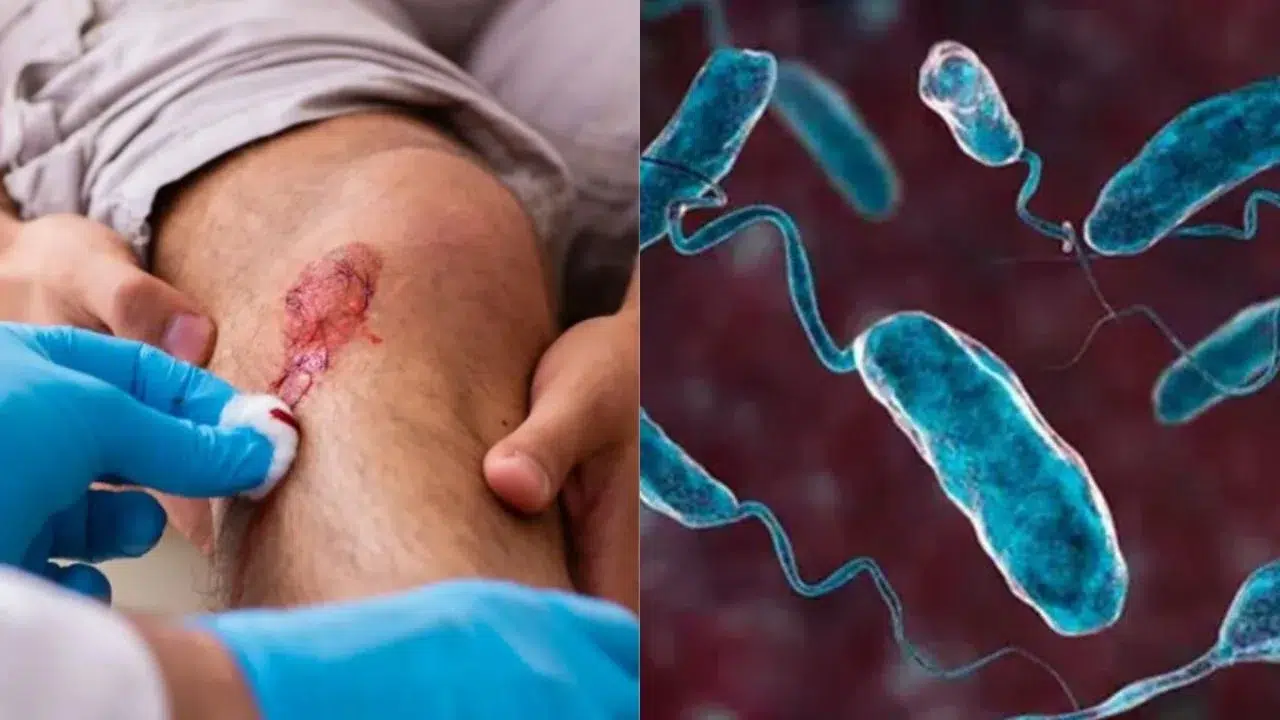 Aumentan muertes por bacteria “come carne”: van ocho personas fallecidas