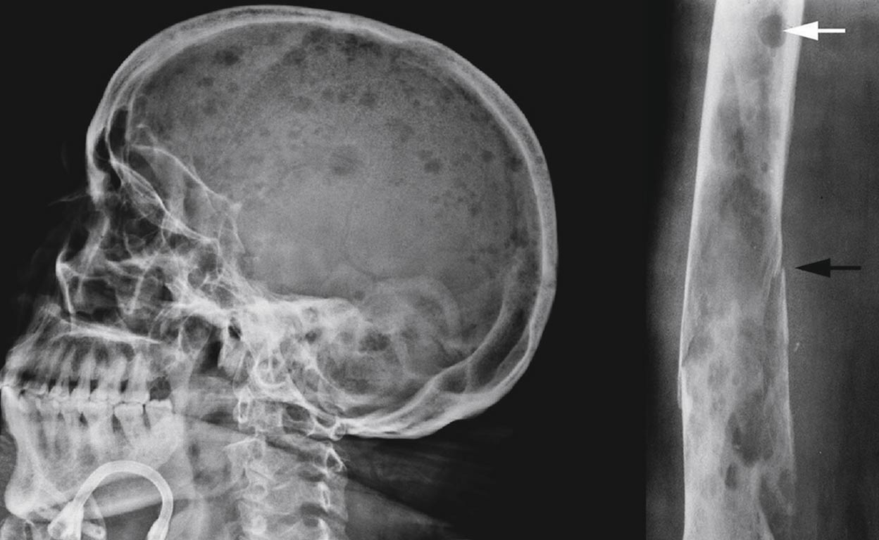 Mieloma múltiple compromete el sistema inmunológico y causa graves complicaciones