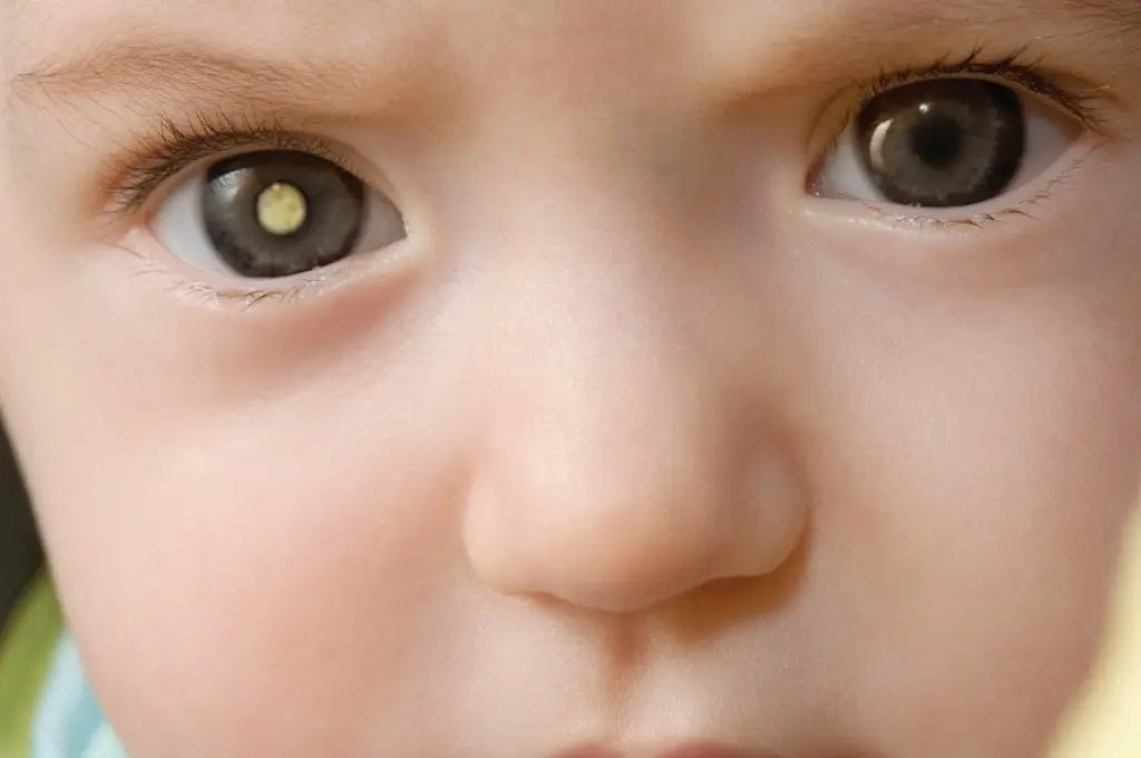 Un reflejo blanco dentro del ojo puede ser señal de peligrosa enfermedad en niños, advierten