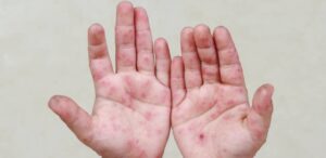 Alerta en Campeche: confirman al menos 23 casos del virus Coxsackie.