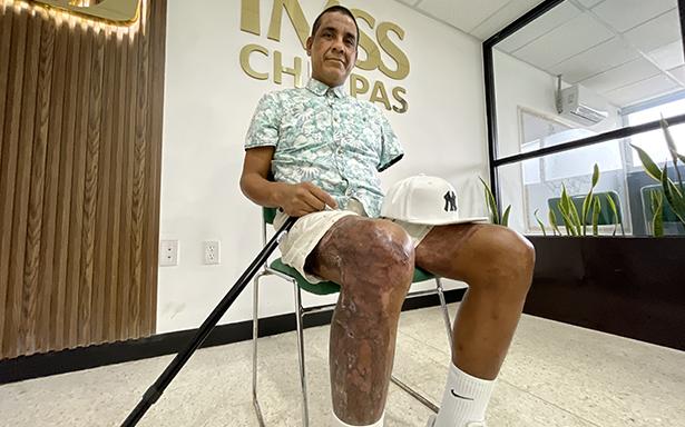 Salvan a paciente electrocutado con técnicas avanzadas de injertos cutáneos