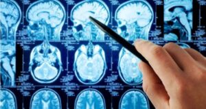 alteraciones neurologicas efectos adicionales del cancer nefrourologico focus 0 0 688 364