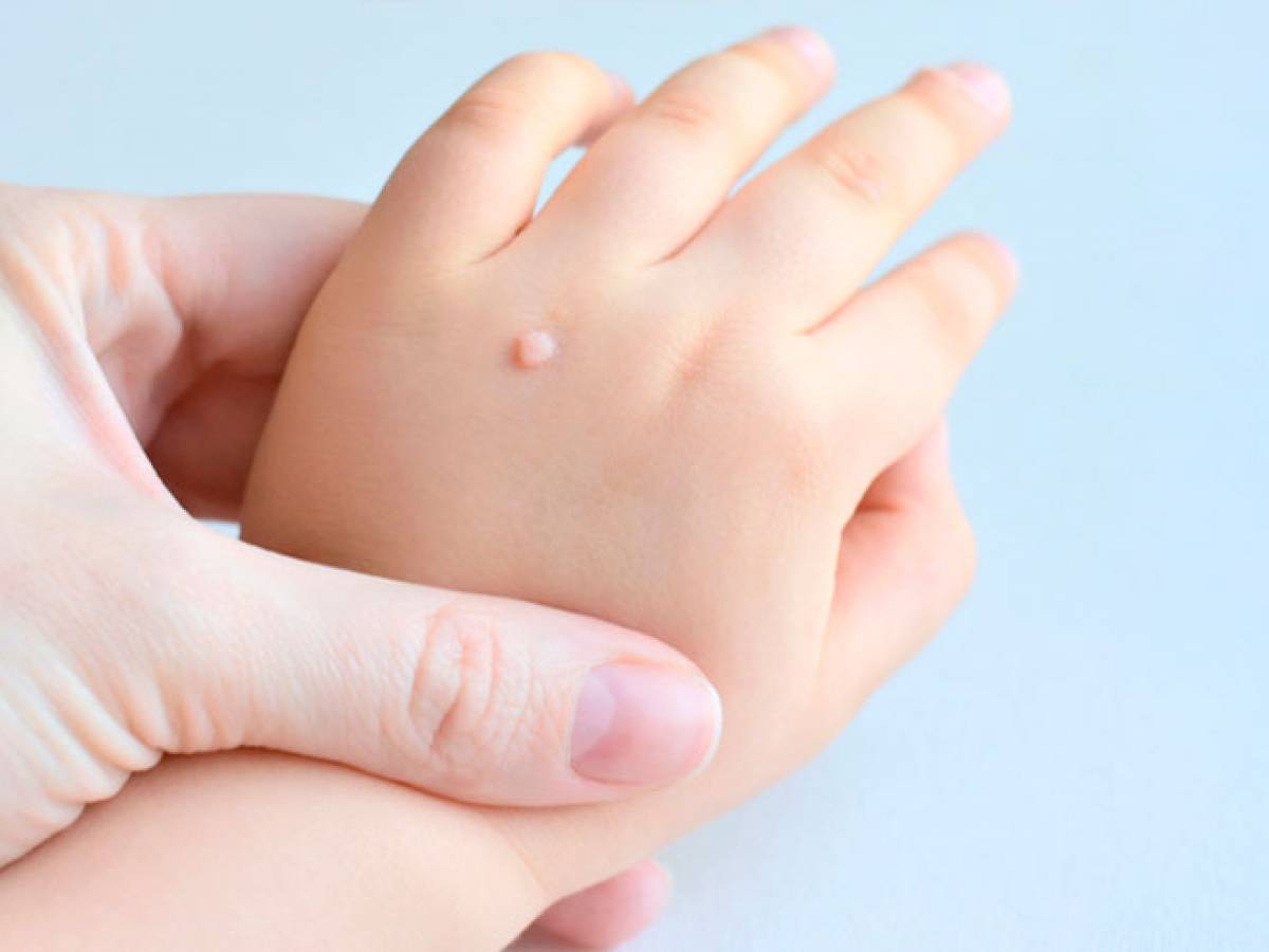 Buscan proteger de papiloma a más de 2 millones de niñas, niños y adolescentes