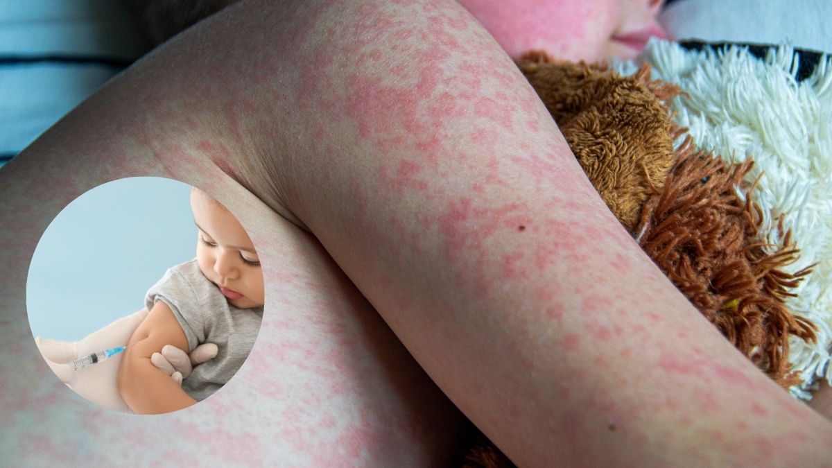 Secretaría de Salud Jalisco urge a vacunarse ante brotes de sarampión