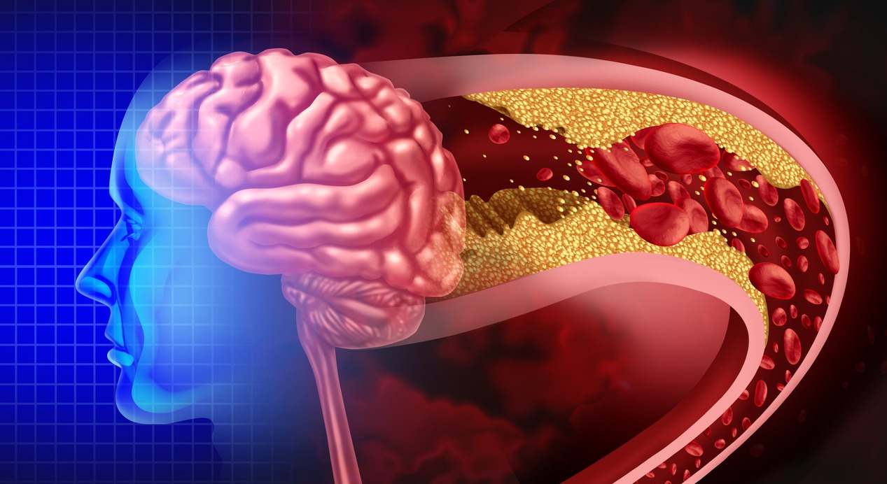 Debilidad en un brazo o pierna y entumecimiento pueden ser señales de ictus