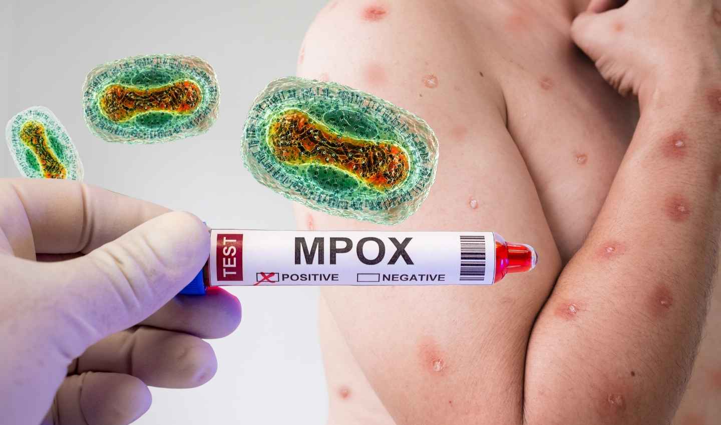 Capacitan a personal de salud en Jalisco para prevenir mpox “viruela del mono”