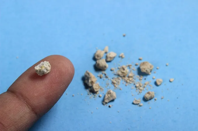 Hospital mexicano recibe equipo médico láser para “pulverizar” cálculos urinarios