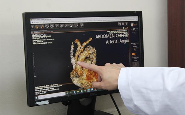 Hospital “La Raza” mejora esperanza de vida de pacientes con disección aórtica, ¿qué es?