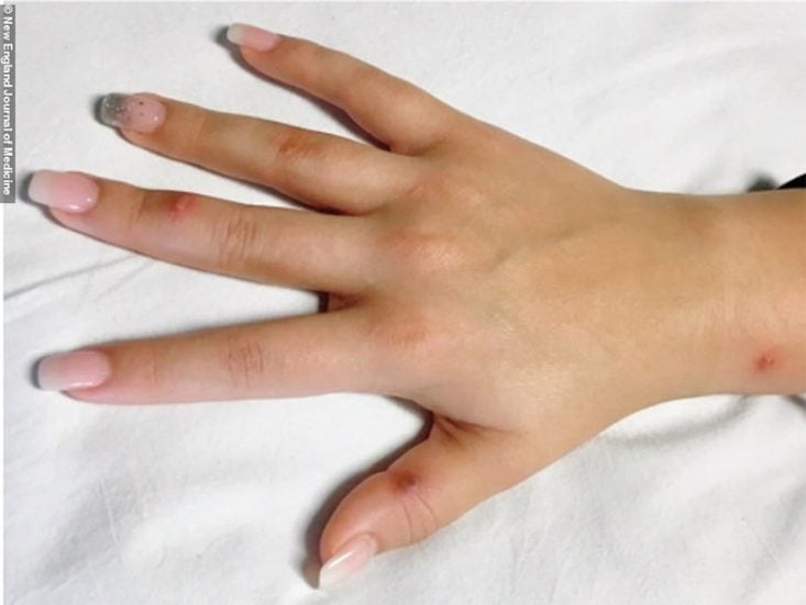 OMS alerta por niveles crecientes de gonorrea farmacorresistente: ¿cuáles son los síntomas en hombres y mujeres?