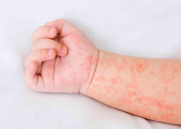 Registran primera muerte por sarampión en Jalisco: 5 primeros síntomas