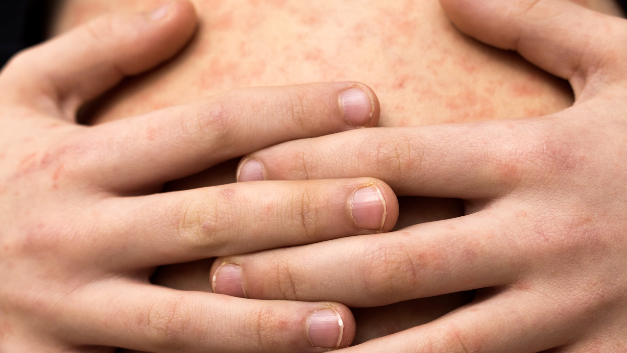 Continúan la lucha contra el sarampión: instalan más macromódulos de vacunación en Jalisco