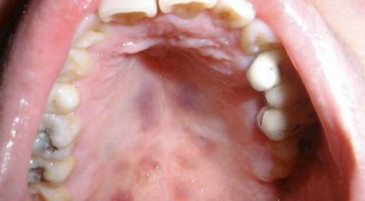 Guía: todos los signos y síntomas de VIH (iniciales, avanzados y al no tratarse)