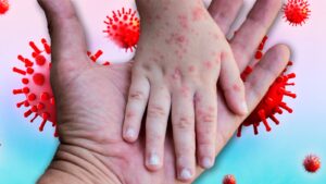 La región de las Américas perdió su certificación de eliminación del sarampión en 2025