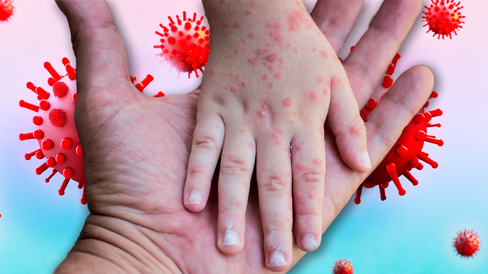 Región de las Américas perdió su certificación de eliminación del sarampión en 2025: México en alerta