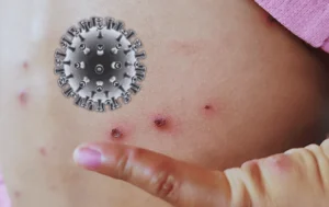 Confirman segunda muerte por sarampión en Jalisco