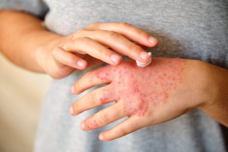 Dermatitis atópica: padecimiento complejo, impredecible y estigmatizante