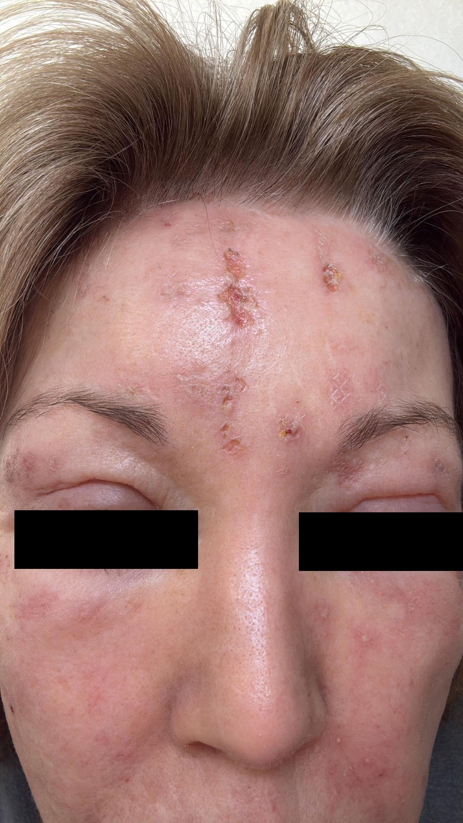 “No sentí ni olí la carne ardiendo” Paciente sufre quemaduras graves en el rostro por tratamiento estético