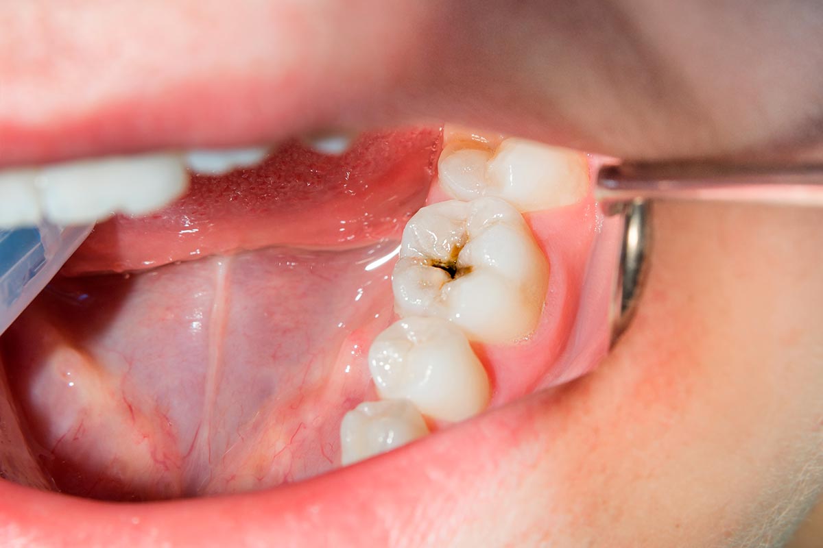 Usar hilo dental antes del cepillado dental nocturno puede evitar caries: IMSS